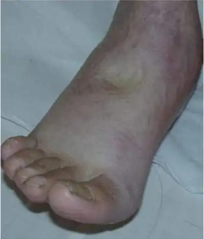 浮肿图 (28)_有来医生