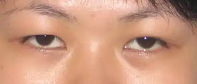 眼皮下垂怎么破? - 好大夫在线