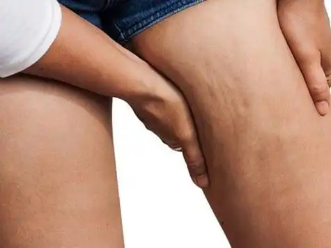 大腿内侧疼痛怎么回事大腿内侧疼痛的原因