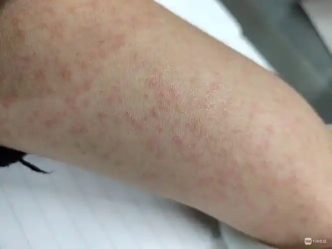 请问社友哪里看皮肤过敏