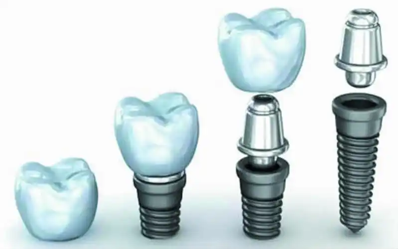 种植牙只是拧上螺丝