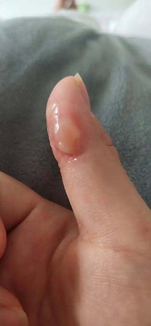 手指被油烫了怎么办? - 知乎