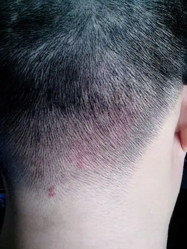 头皮上长成片的小红疙瘩 很痒 挠后很疼 破溃 痛苦不已 求大家帮助