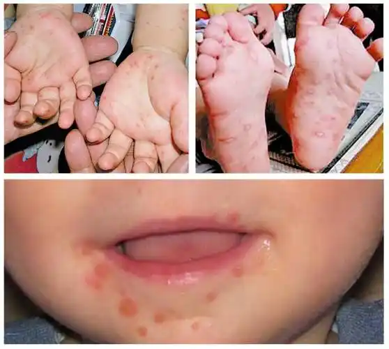 宁波宝宝可接种手足口病疫苗了,最全服务门诊看这里!