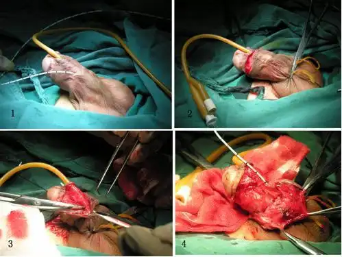 包皮脱套式修补法治疗尿道下裂术后尿瘘