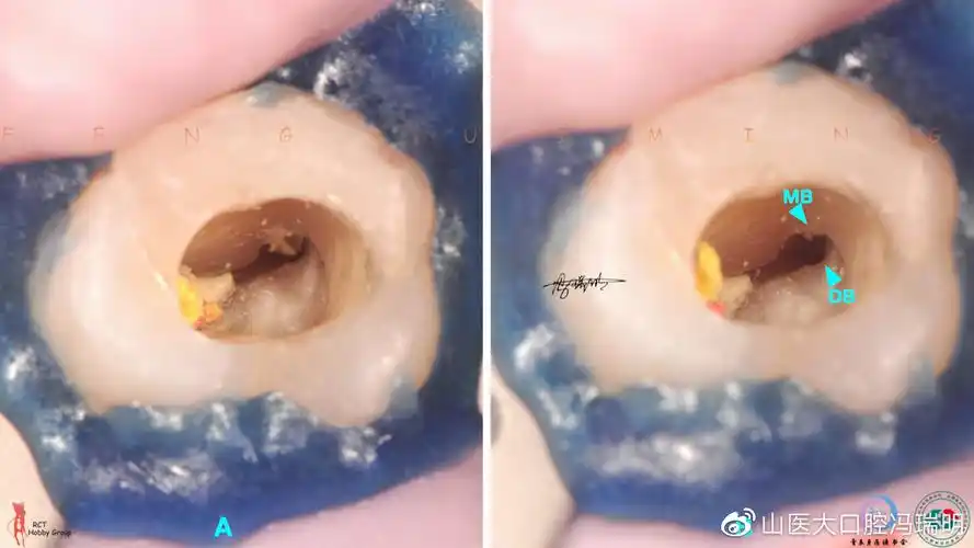 上颌第二磨牙根管解剖形态特点及病例分享