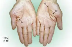 胃癌病人掌纹