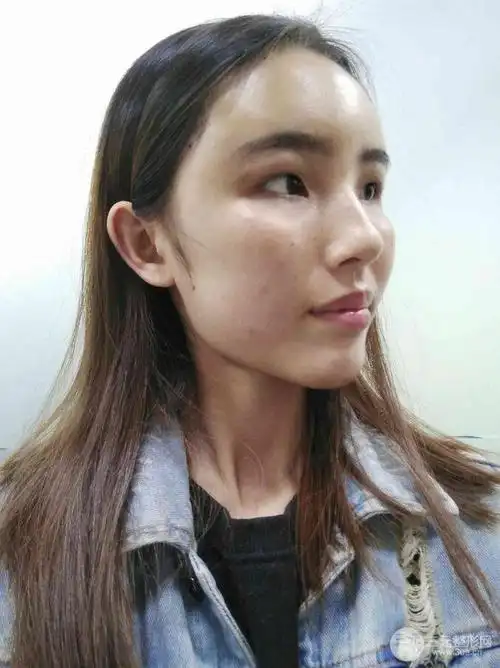 额头填充对比照片自体脂肪填充全脸案例恢复过程分享