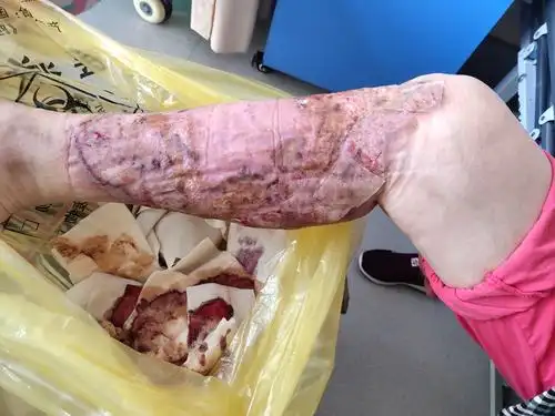 11.4陆瑞红右小腿皮肤溃疡换药录