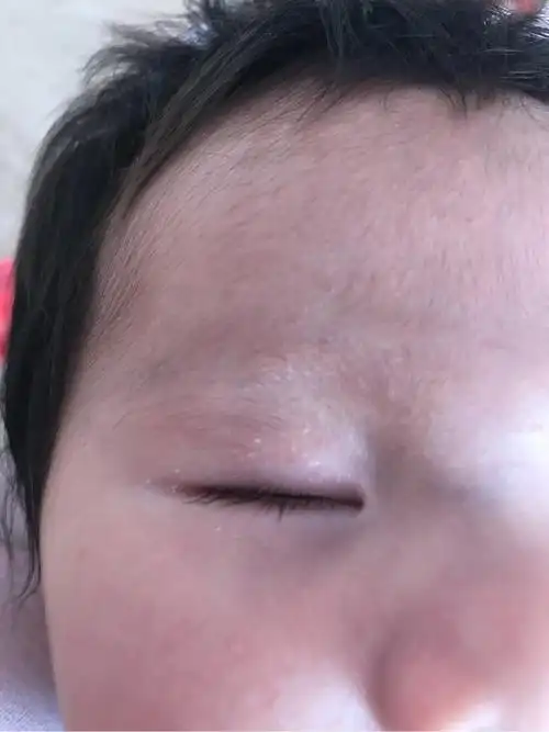 宝宝眼皮蜕皮有时候还会肿