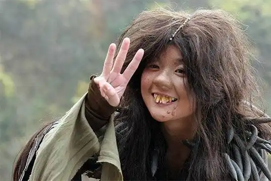 龅牙矫正的两种方法 告别你的兔子牙