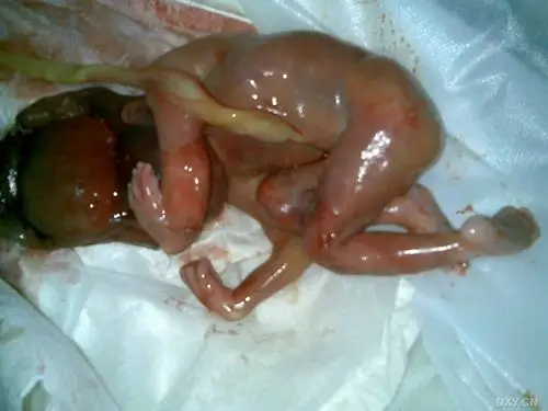 【讨论】大家看看这个胎儿(引产后照片已发20081016) [精华]