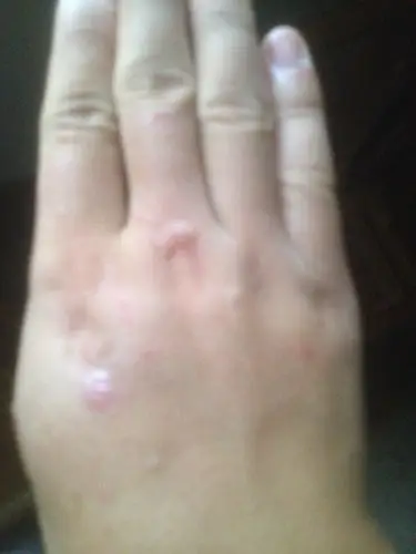 去了医院买药膏,医生说没得治这种鱼鳞的药膏!求解!谢