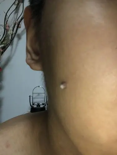 脸上长了块肉(硬硬的消不掉)