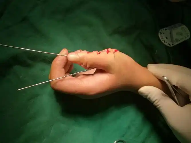 对掌位骨针固定