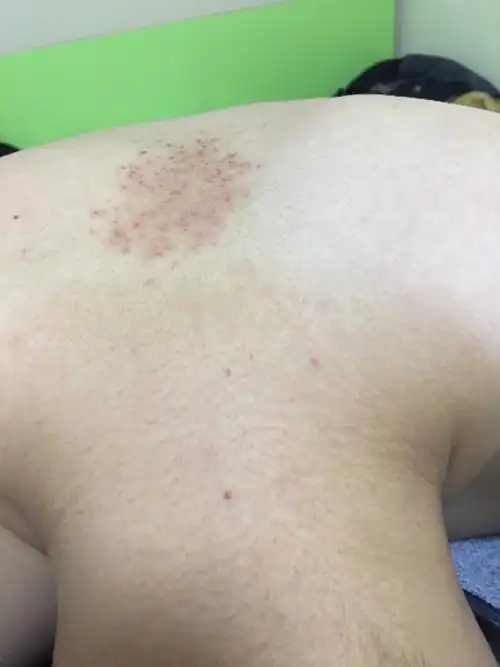 背部的是什么皮炎?