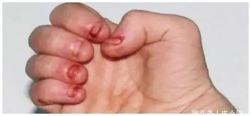 小王唯一担心的是他儿子天天咬手指的问题,有时甚至咬孩子沉迷肯指甲