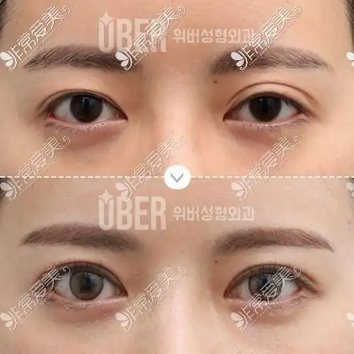 韩国玉芭整形眼提肌修复前后对比图