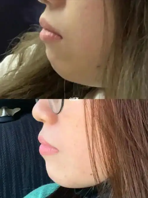 戴牙套一年侧脸效果