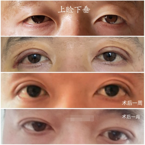 上睑下垂案例_上睑下垂_上睑下垂治疗方式 - 好大夫在线