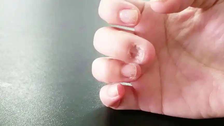 女子养成咬指甲的坏习惯!现在手指甲和牙齿变得惨不忍睹!