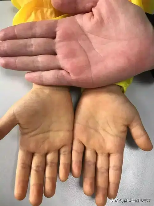 今天接诊了一个手脚皮肤越来越黄的孩子,我却让她回去了!