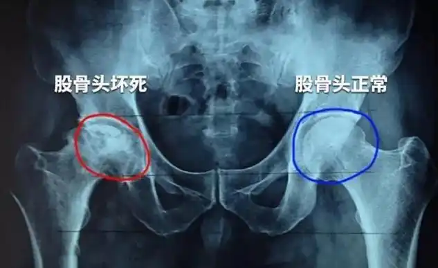 股骨头坏死的病因怎么治疗股骨头坏死和股骨头坏死的营养疗法