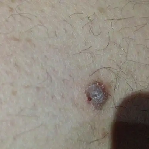 大腿外侧长了一个硬疙瘩,很长时间了,平时不疼不痒,挠的厉害的