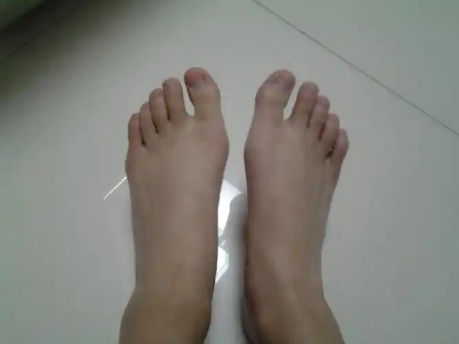 初中开始蹲着写作业,现在高二,然后就得了拇外翻(俗称大脚骨),这样算