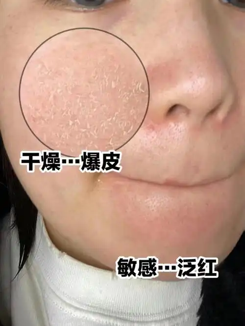 六大皮肤屏障受损问题自查!