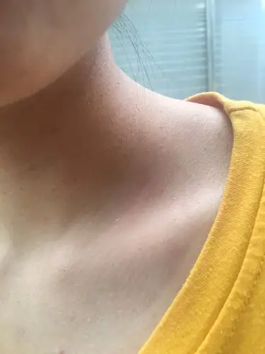 背部出现很多黑点,不知道怎么解决,看了医生,不过没用