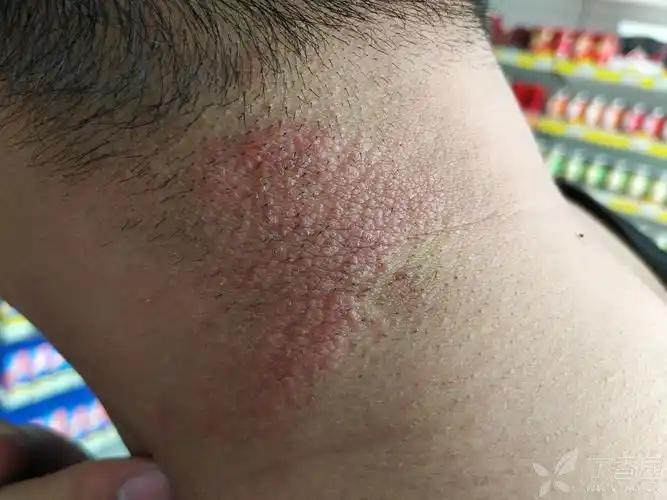 慢性单纯性苔藓一例(神经性皮炎) - 皮肤与性传播疾病讨论版 -丁香园