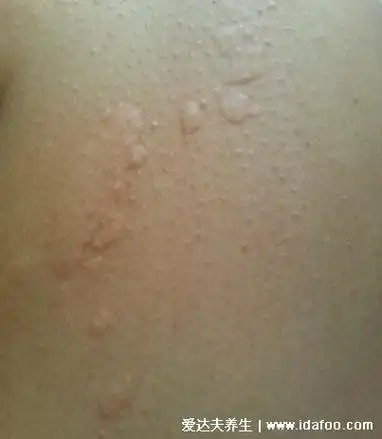 1,急性荨麻疹急性荨麻疹发病很急,主要是过敏引起的,皮肤突然长这种