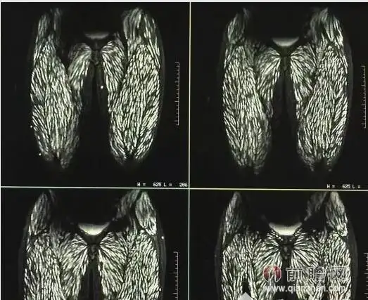 23岁女子常吃生肉全身长满了寄生虫密密麻麻很恐怖