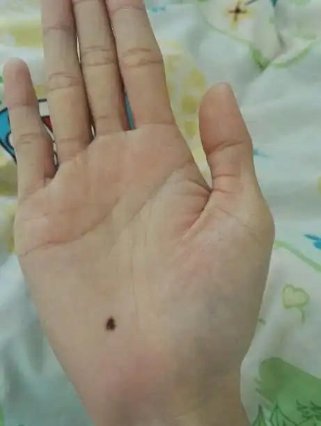 寻找手掌心有痣的有缘人