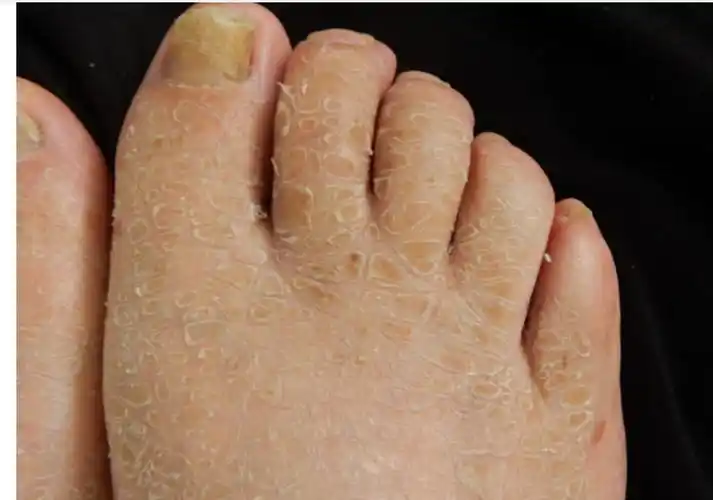 鱼鳞病患者要小心胃癌_鱼鳞病_鱼鳞病介绍 - 好大夫在线