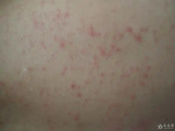 皮肤病成人麻疹