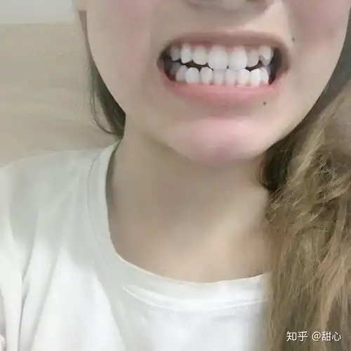 龅牙虎牙怎么矫正?