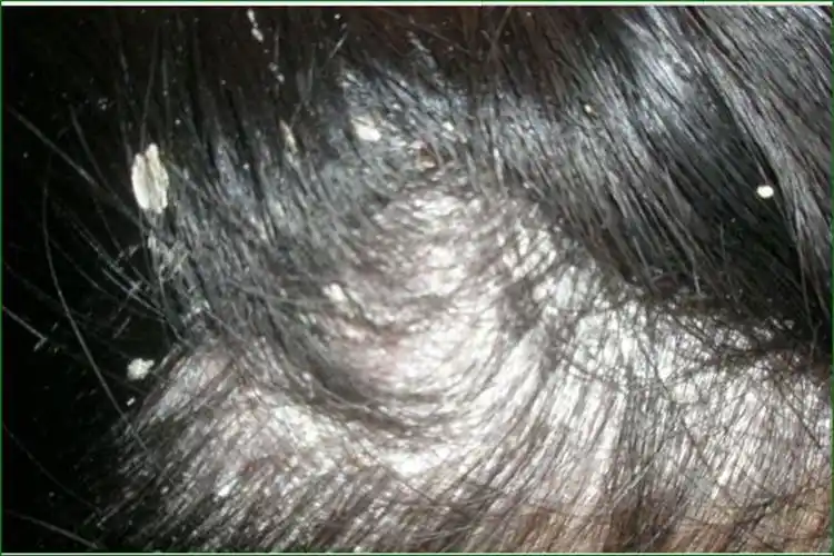 女生的头癣初期图片_有来医生