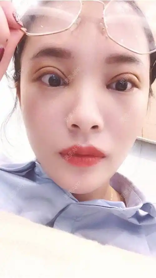 更美用户koiddfv100的全切双眼皮日记