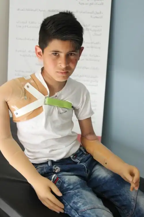 失去双臂的小男孩在假肢安装之后,第一次