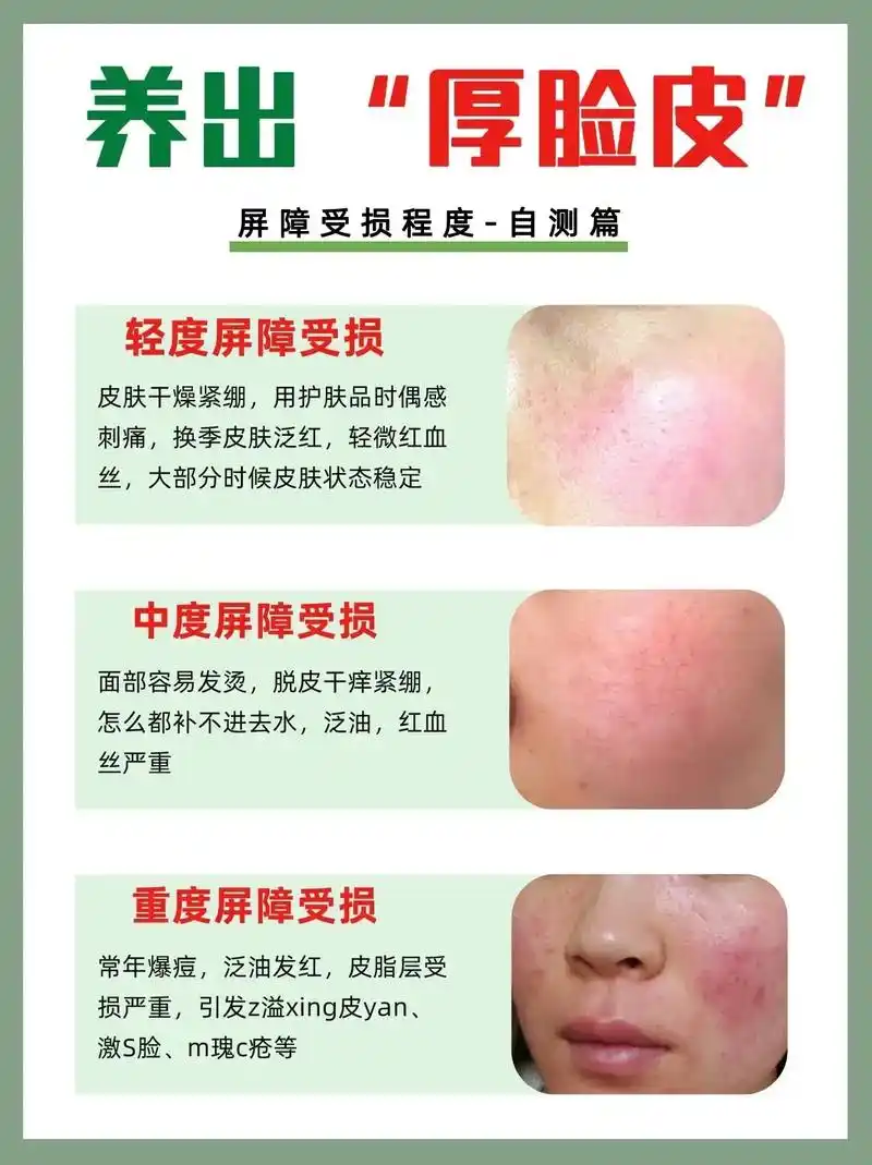 养出"厚脸皮"019969♀15屏障受损修复.