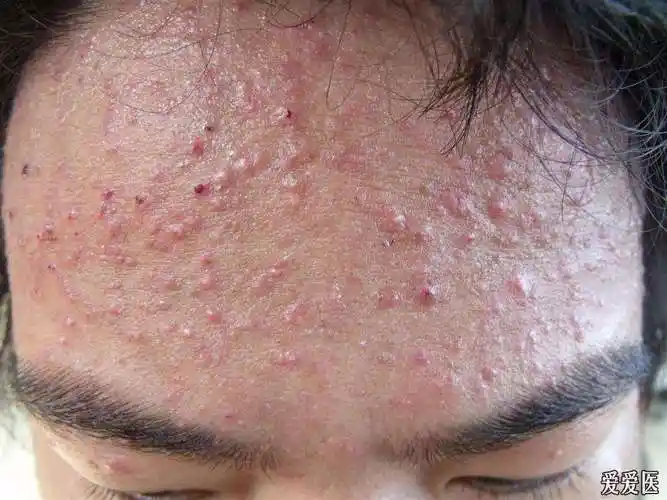 毛囊炎的病因,症状和治疗方法