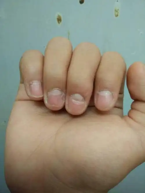 手指甲根部有一小块指甲自己就没了,很脆,像个小洞,里面还是一层指甲