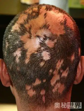 其实斑秃俗称"鬼剃头",是一种骤然发生的局限性斑片状的脱发性毛发病.
