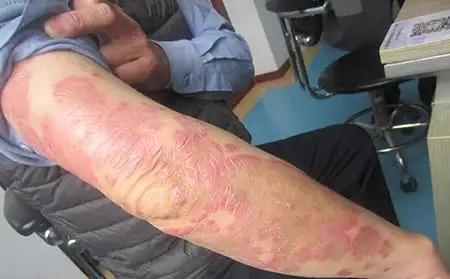 牛皮肤癣的种类图片症状原因和治疗方法_潍坊东方银屑病研究院