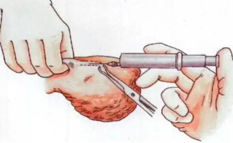 输精管穿刺技术