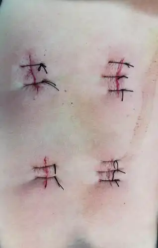 术后皮肤缝合切口外观