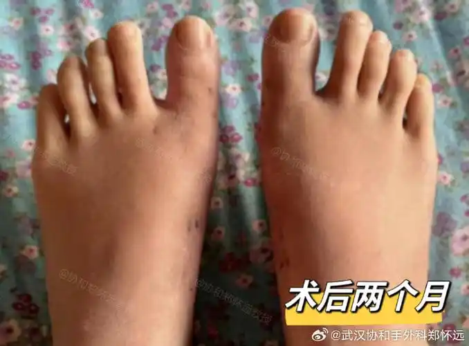 微博健康公开课##拇外翻##协和郑怀远教授