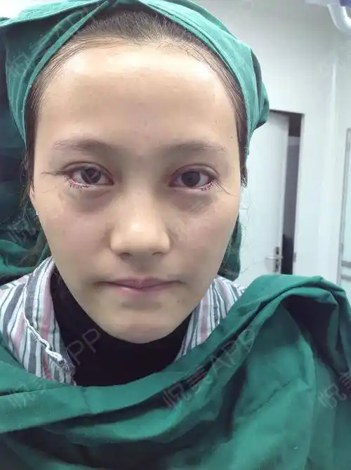 我做的是兰乔的网红项目下至外眼角,这个真的挺适合我做的,因为我的眼